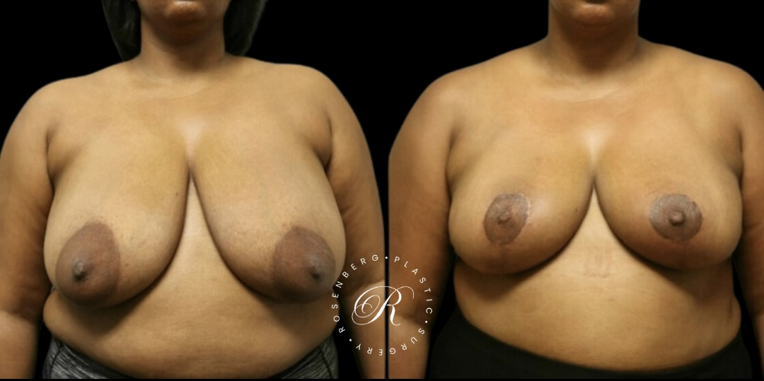 Breast Lift & Reduction RPS Before & Afters.zip - 89