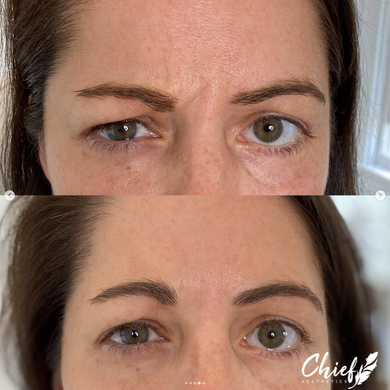 aesthetic-symmetry-reduced-facial-tension-Chief-Aesthetics-Western-NY-2