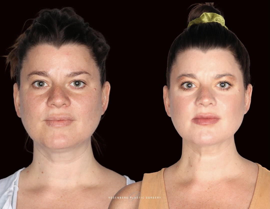 Neck Liposuction Results