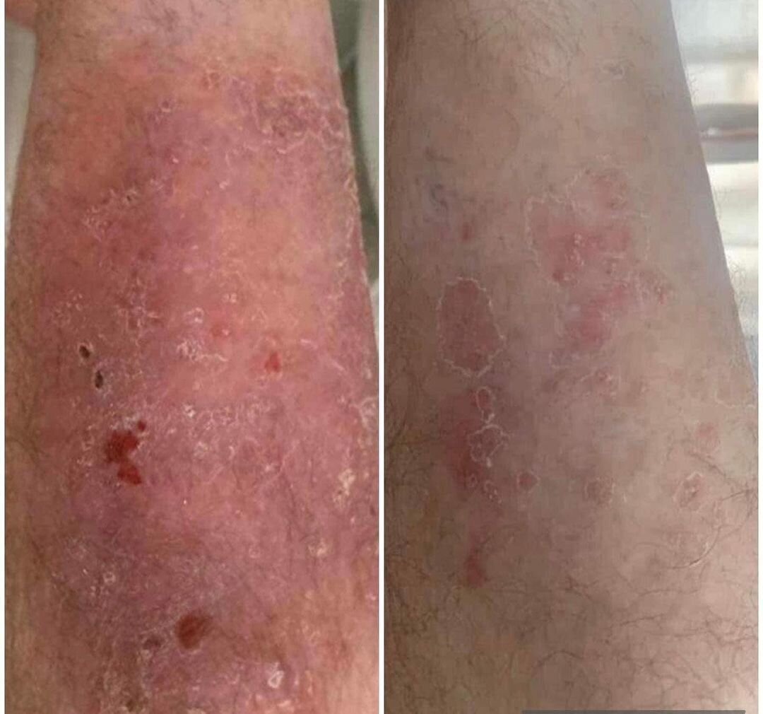 Psoriasis - Photo Courtesy of Sante Second Regard