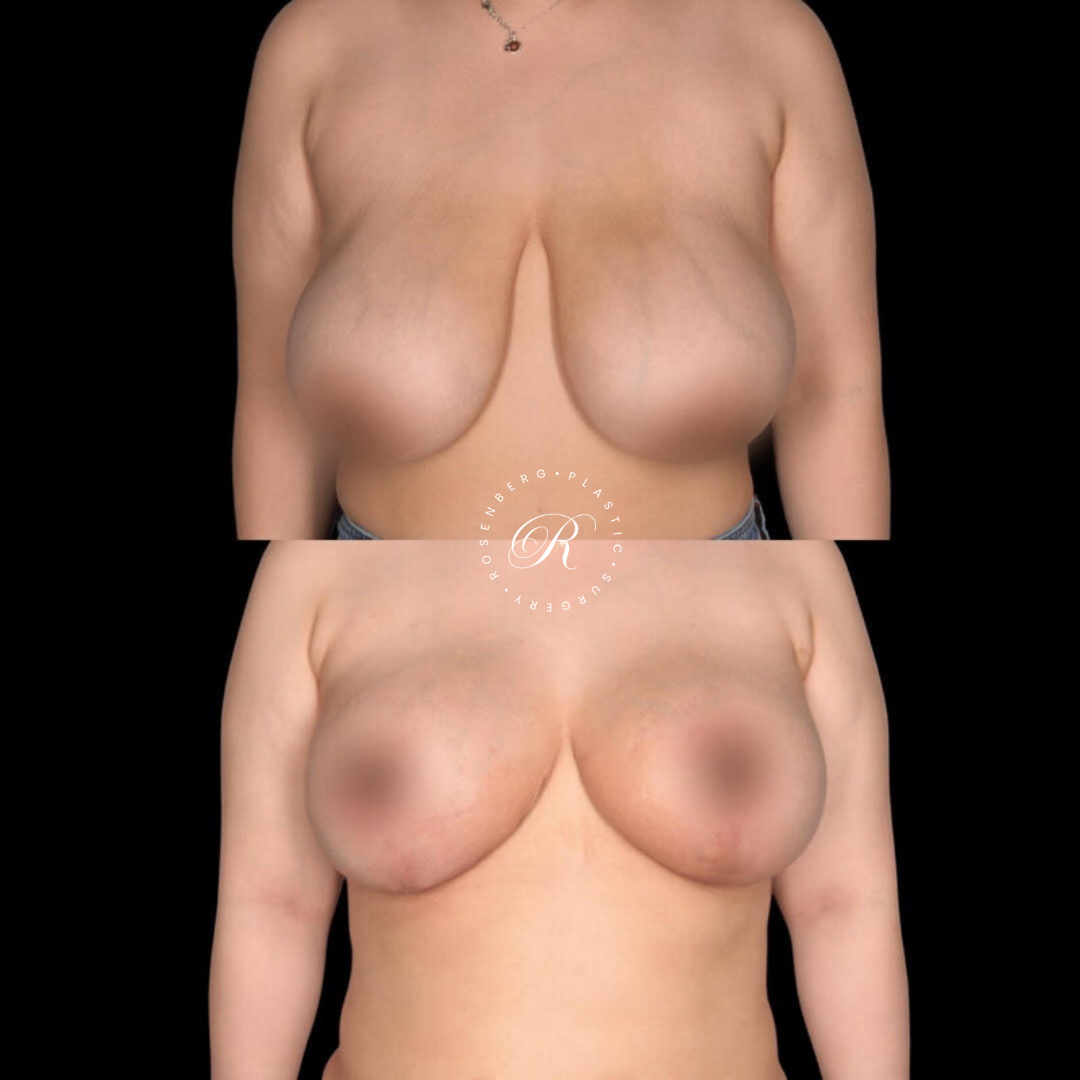 Breast Lift & Reduction RPS Before & Afters.zip - 63