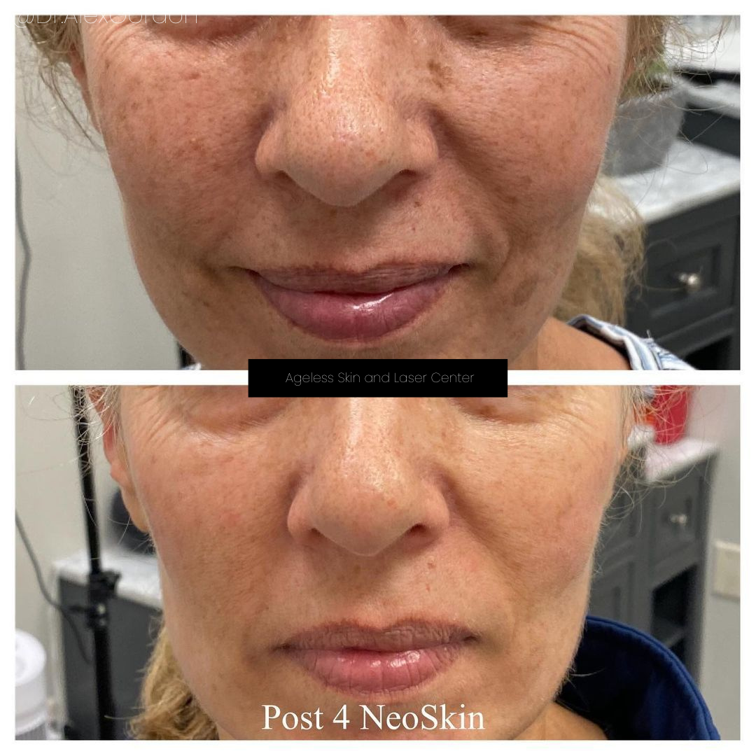 Neo Elite® - NeoSkin® - Skin Rejuvenation