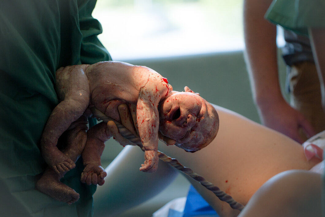 A baby girl is born into the doctors hands  and is still attached by umbilical cord.