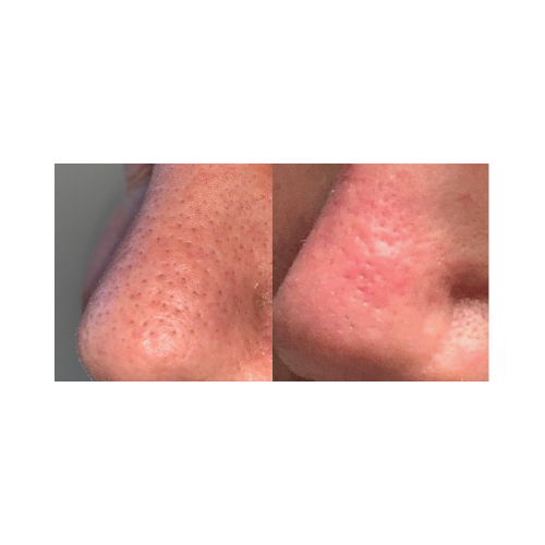 Pore refinement and smoother skin texture post HydroDerm