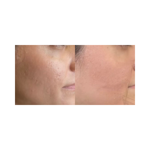 Improved skin elasticity and tone after DermalPen sessions