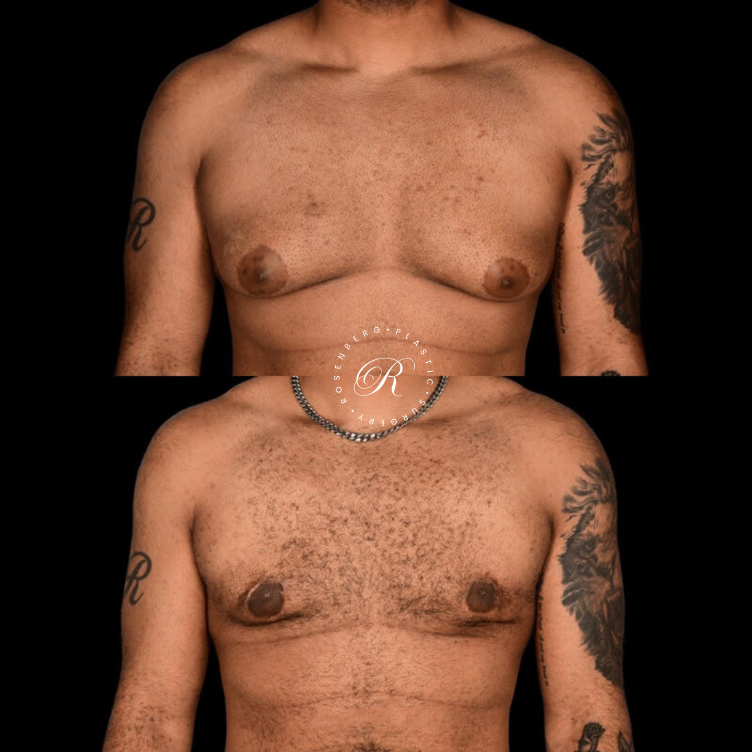 Gynecomastia RPS Before & Afters.zip - 1