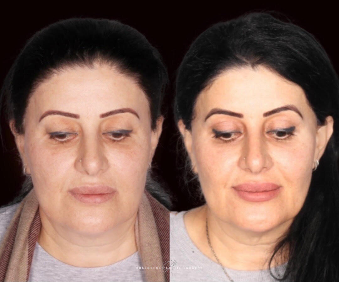 Blepharoplasty Results