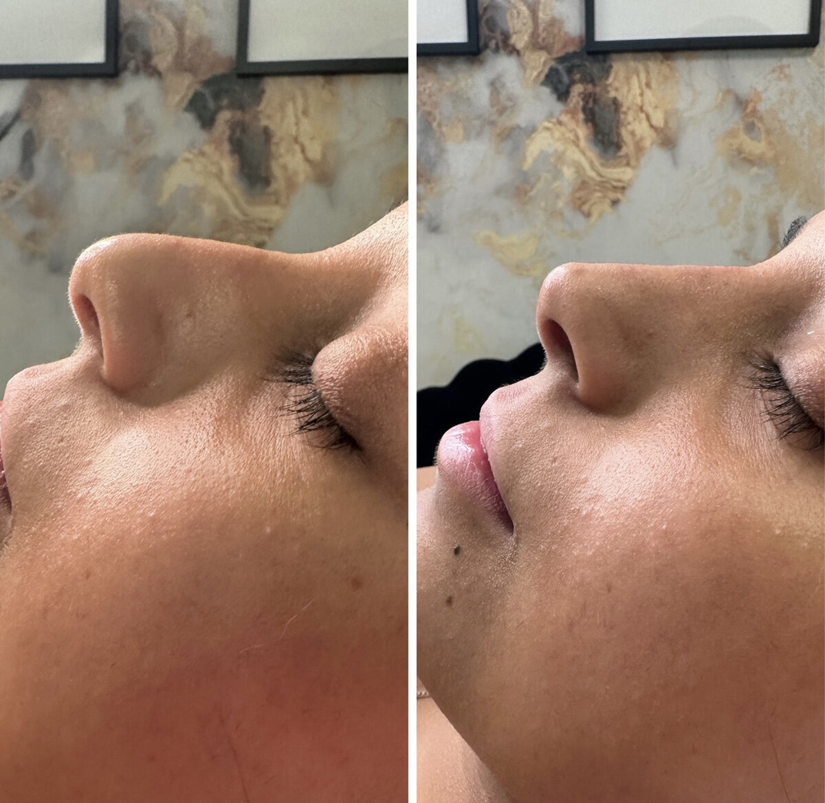 W Aesthetics Non Surgical Rinoplasty  Before and After Austin Texas6