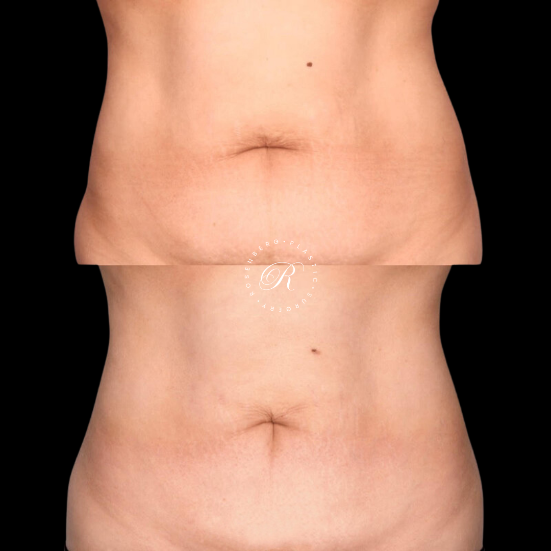 Liposuction of Abs, Back and Flanks RPS Before & After.zip - 12