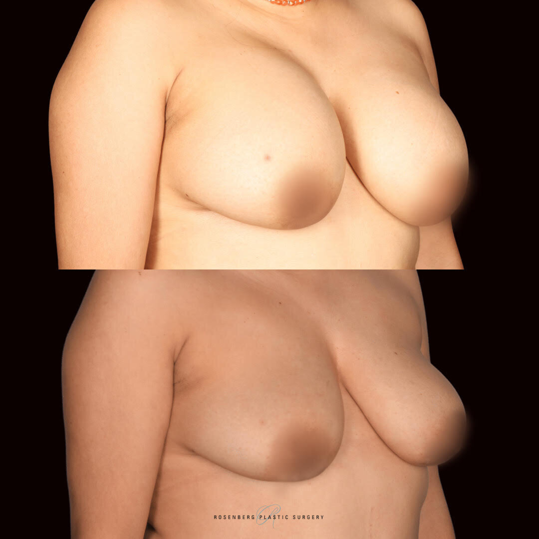 Breast Implant Removal Results