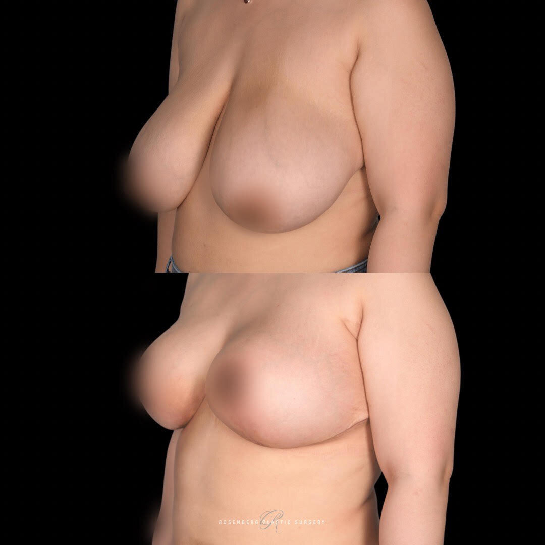 Breast reduction Annie3