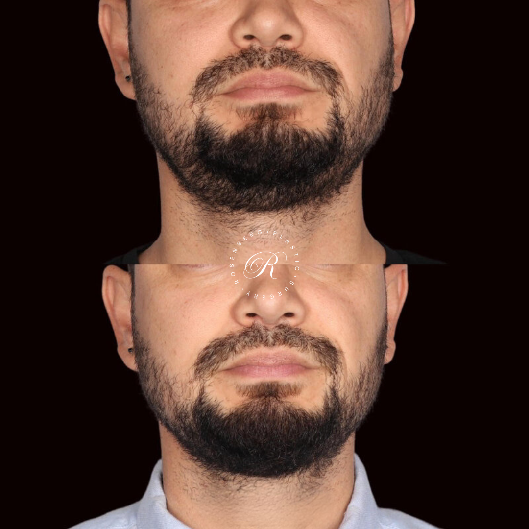Neck Lipo RPS Before & After.zip - 33