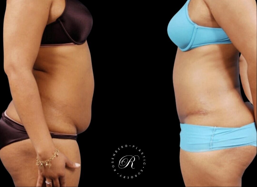 Abdominoplasty RPS Before & After.png