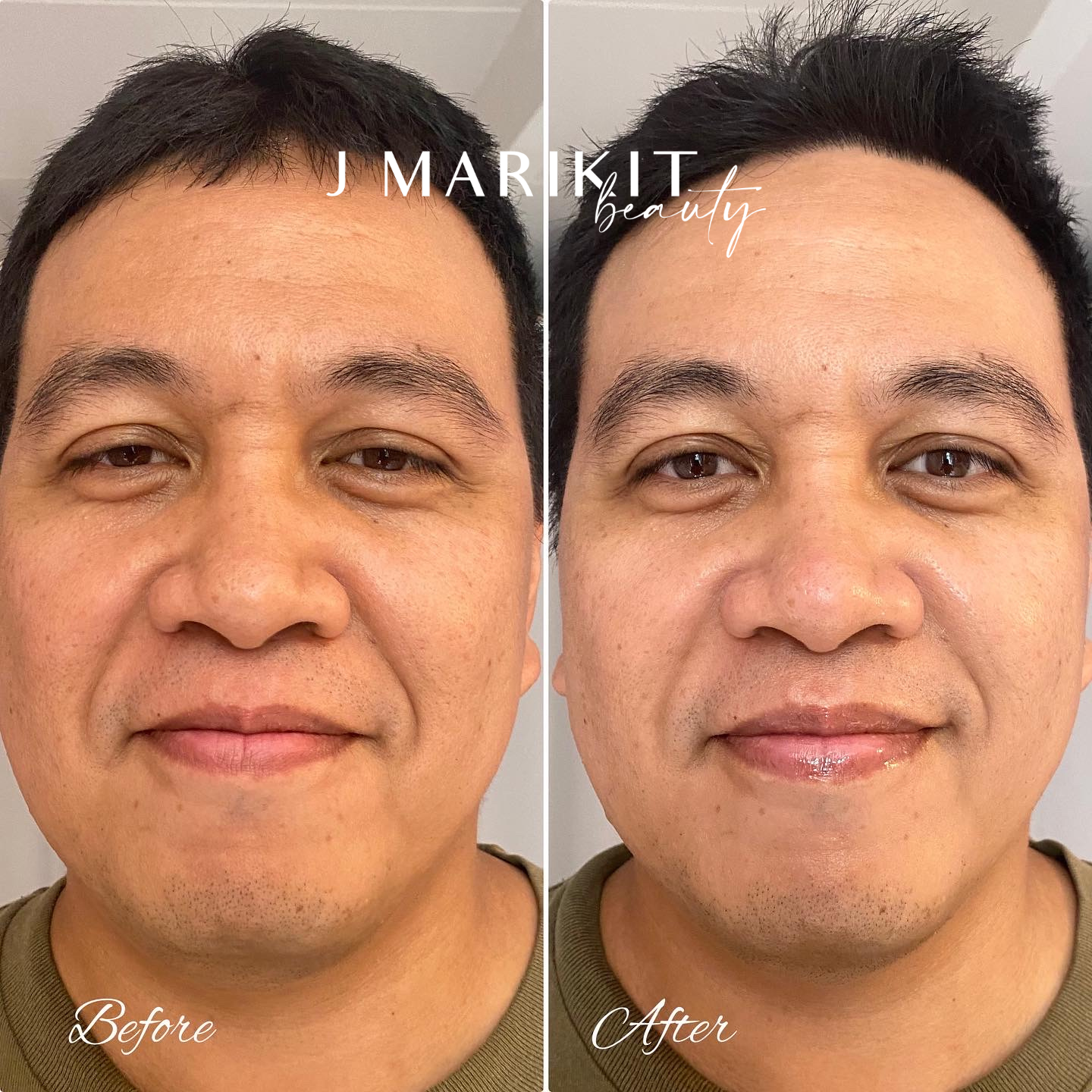 Client before and after images of skin therapy services provided by JMarkit