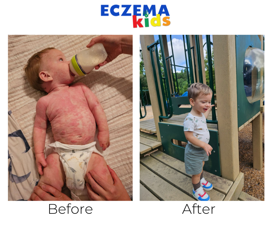 Eczema healing Palmer