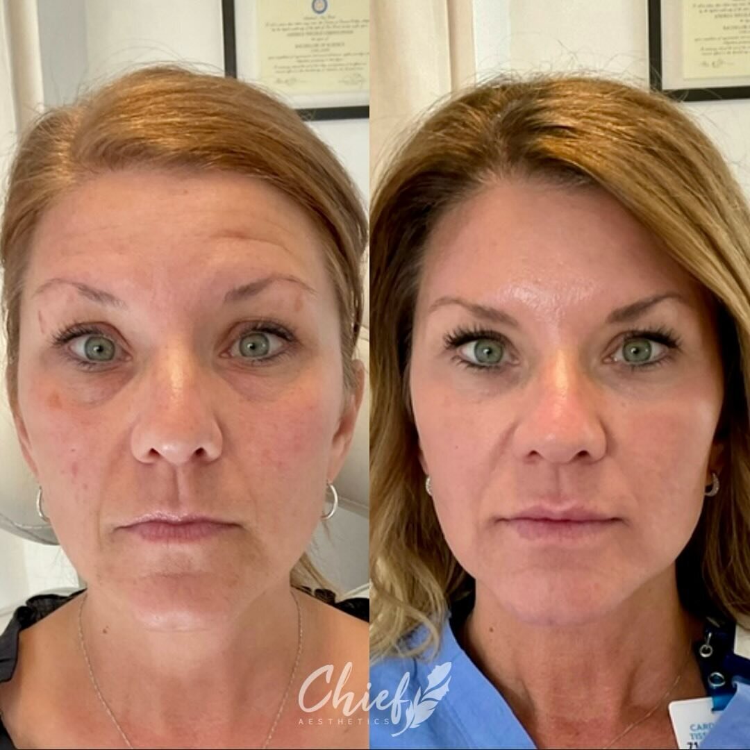 Full-face-Xeomin-fillers-buffalo-ny-chief-aesthetics