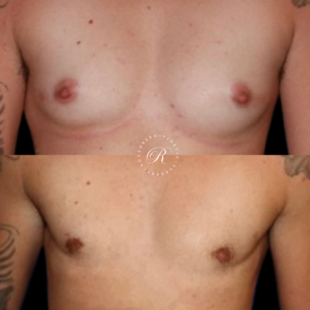 Top Surgery RPS Before & After.zip - 7