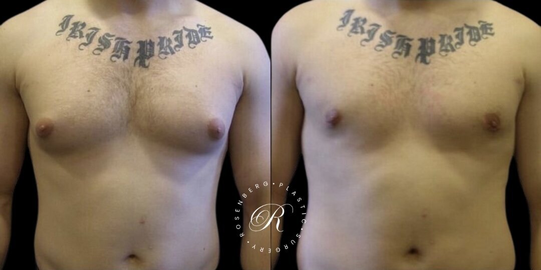 Gynecomastia RPS Before & Afters.zip - 8
