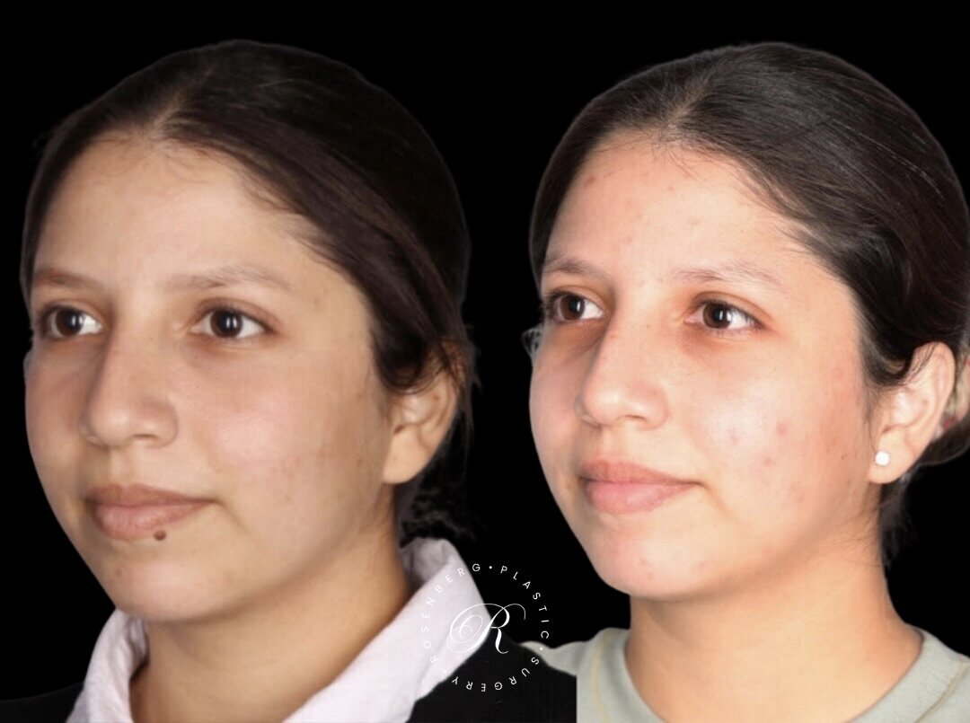 Mole Removal RPS Before & After.zip - 1