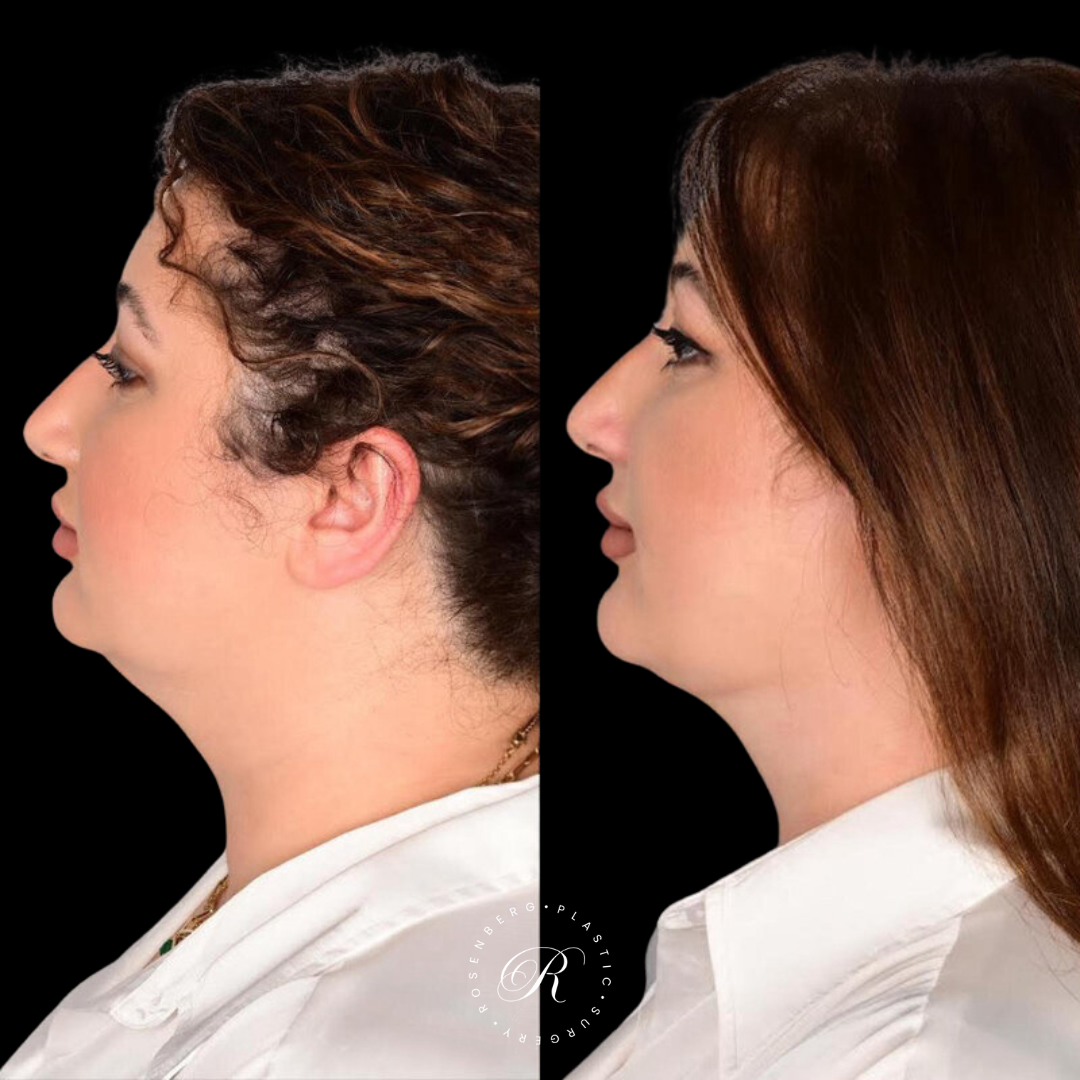 Neck Lipo RPS Before & After.zip - 17