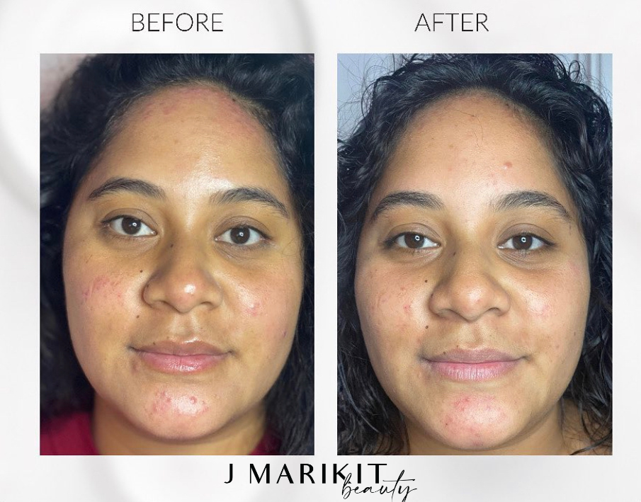 Before and after images of skin health treatment services. Looking for exfoliation near me? JMarkit offers the best beauty services Oahu has to offer.
