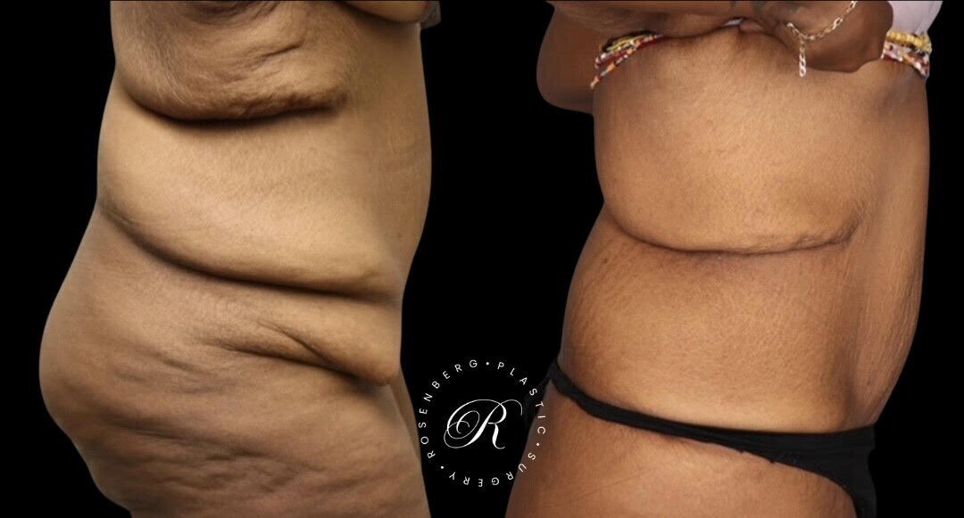 Panniculectomy RPS Before & After.zip - 1