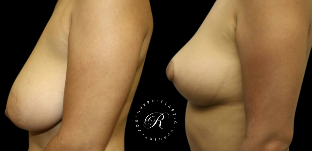 Breast Lift & Reduction RPS Before & Afters.zip - 91