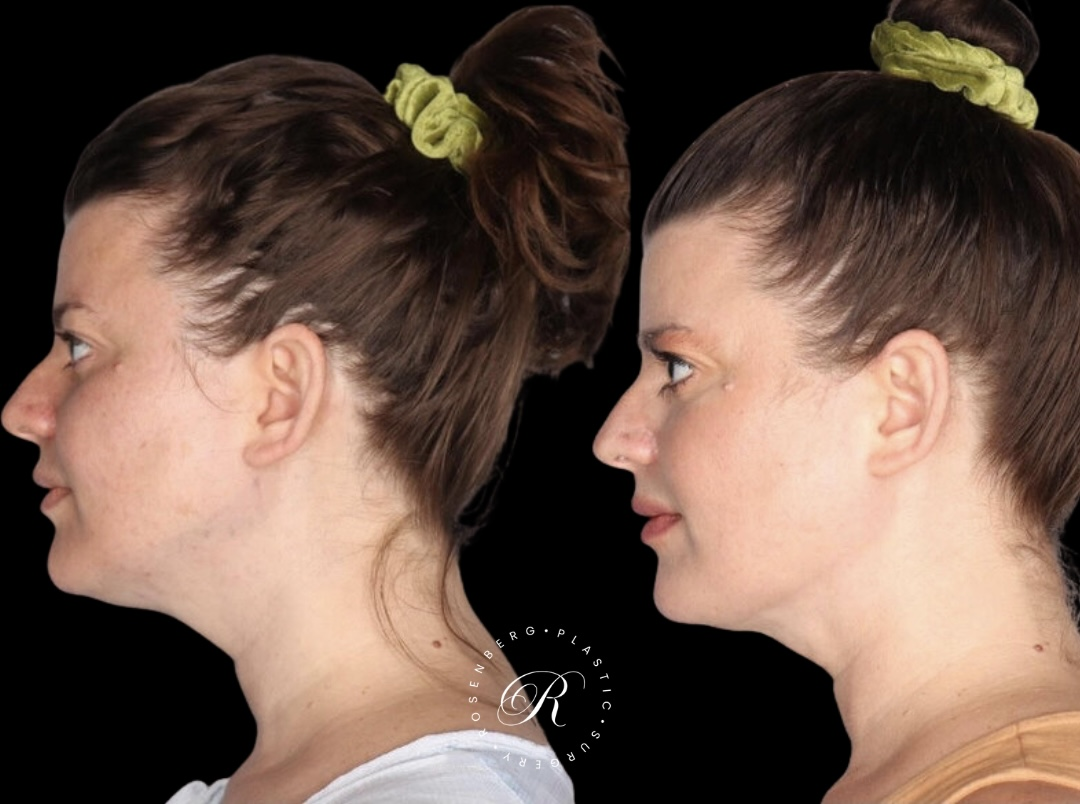 Neck Lipo RPS Before & After.zip - 2
