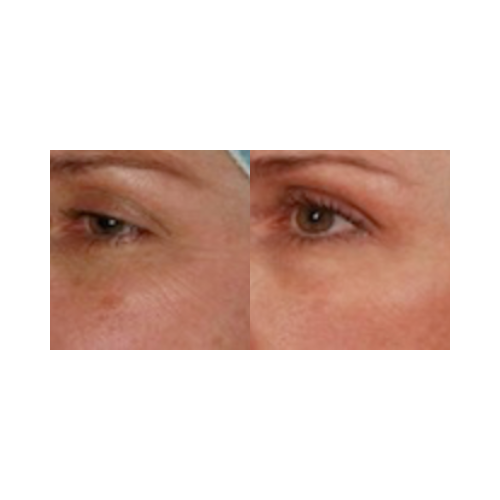 Skin texture improvement post UltraLight CO₂ laser treatment
