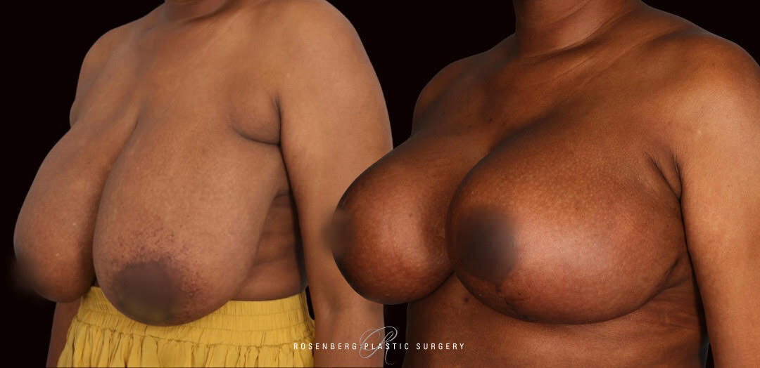 Natasha Nzara Breast Reduction and Lift R 45