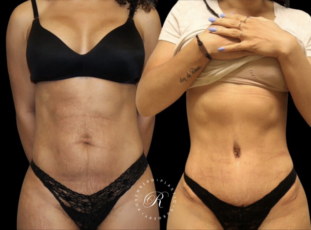 Abdominoplasty RPS Before & After.zip - 8