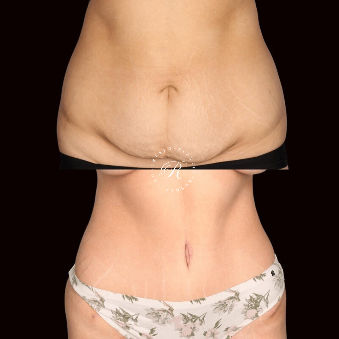 Abdominoplasty RPS Before & After.zip - 1