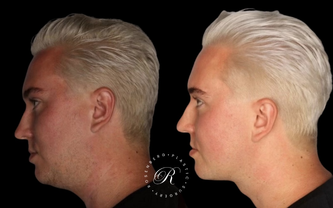 Neck Lipo RPS Before & After.zip - 7