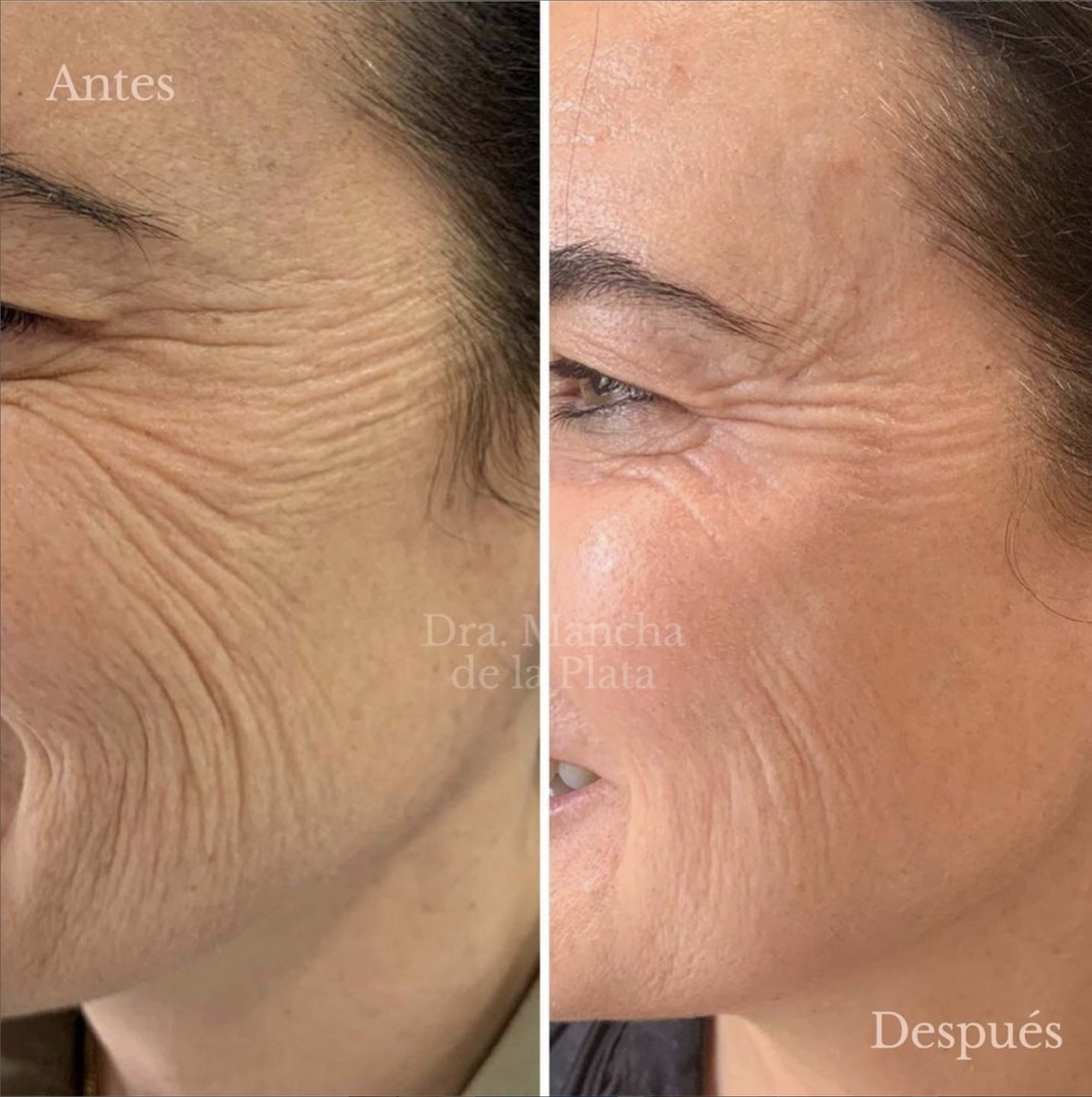 Neo Elite® - NeoSkin® - Skin Rejuvenation (5)