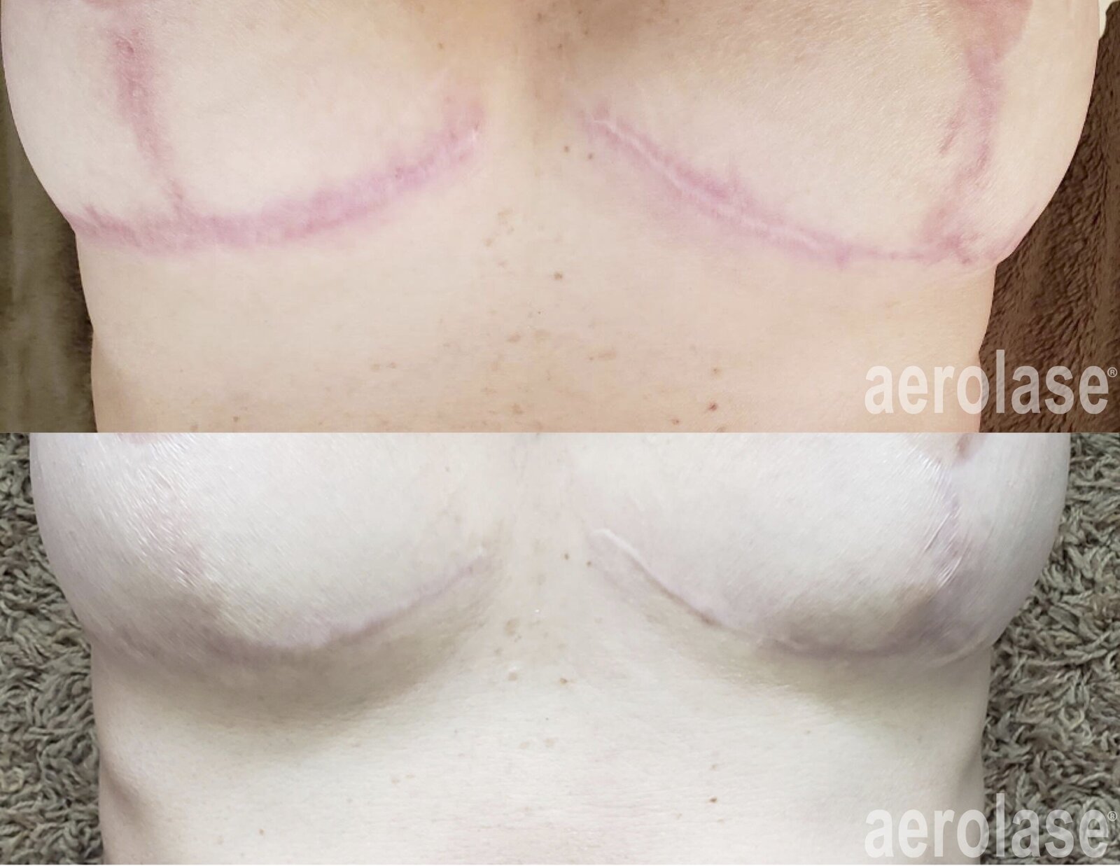 Post-Surgical Scars - Aerolase