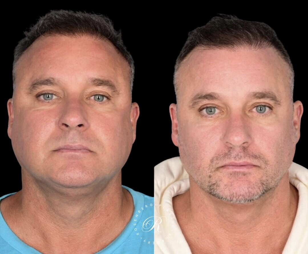 Buccal Fat Pad Removal RPS Before & After.zip - 3