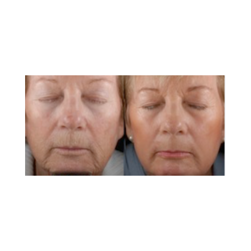 Scar revision treatment results with UltraLight CO₂ laser system