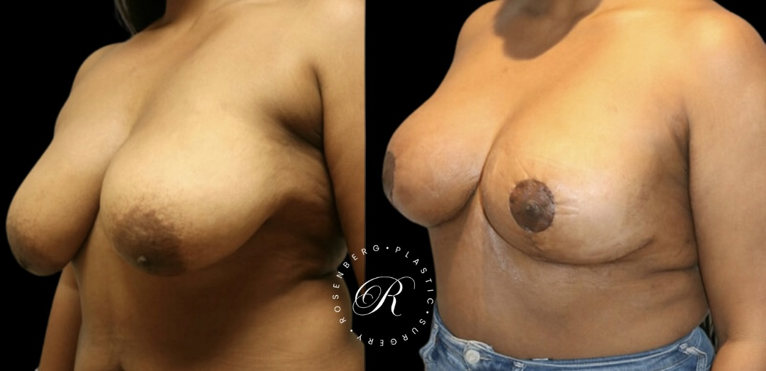 Breast Lift & Reduction RPS Before & Afters.zip - 92