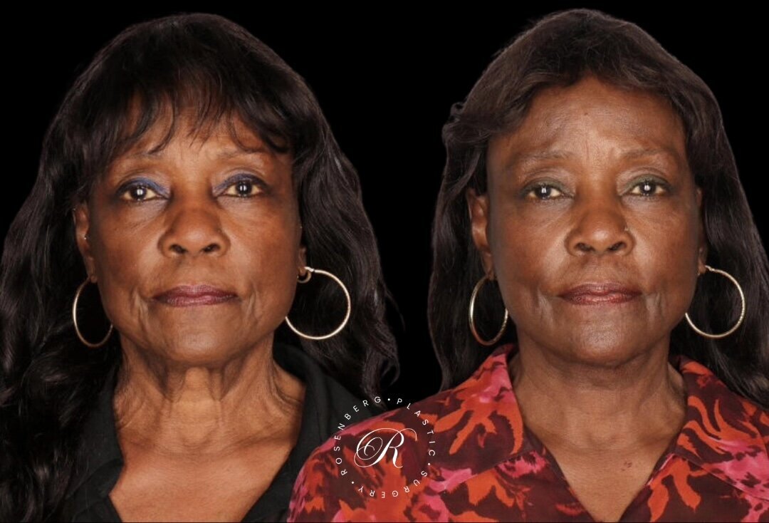 Facelift RPS Before & After.zip - 6