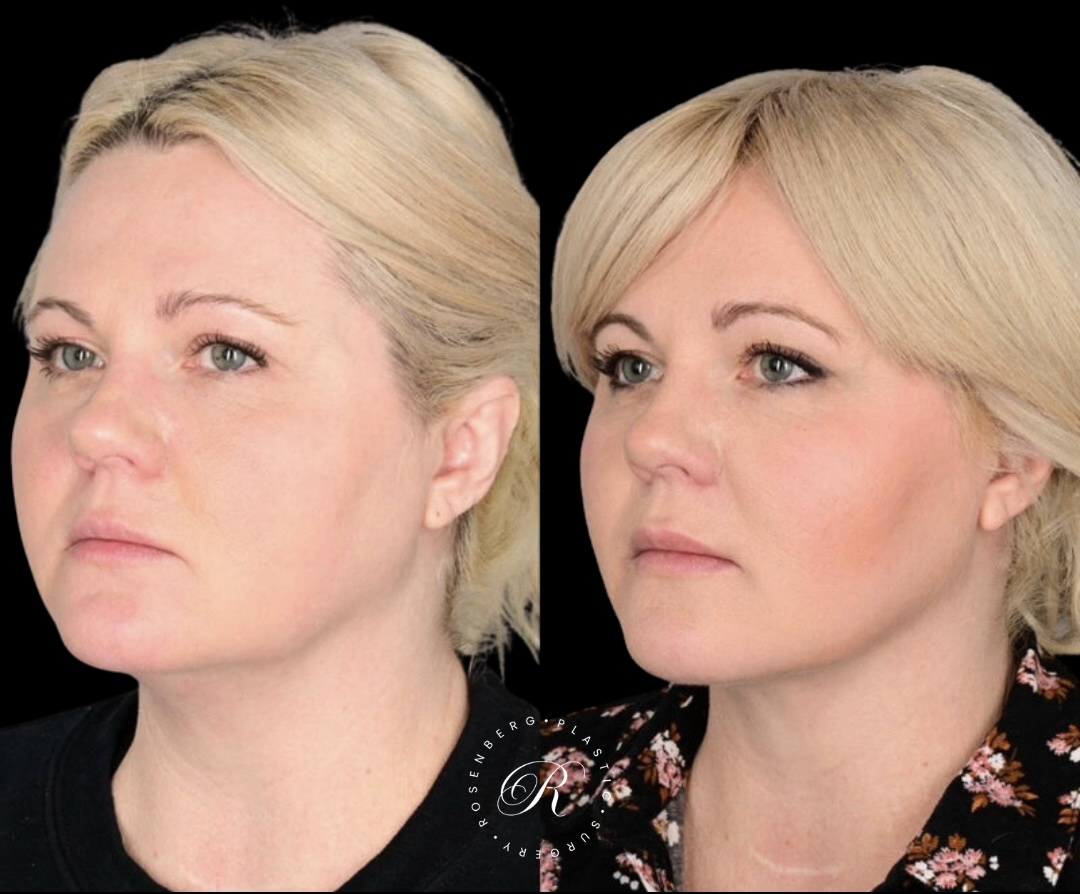 Neck Lipo RPS Before & After.zip - 21
