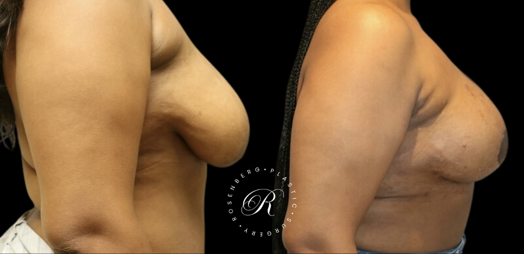 Breast Lift & Reduction RPS Before & Afters.zip - 94