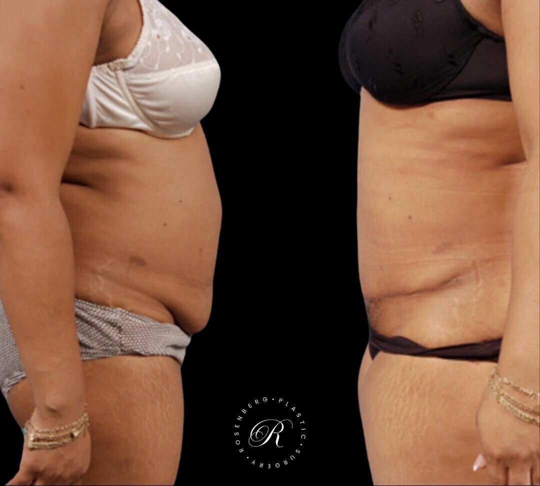 Abdominoplasty RPS Before & After.zip - 13