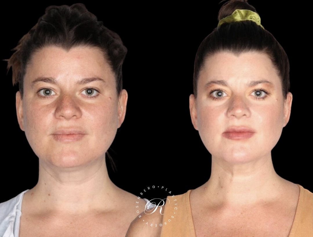 Neck Lipo RPS Before & After.zip - 1