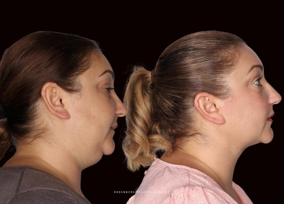 Neck Liposuction Results