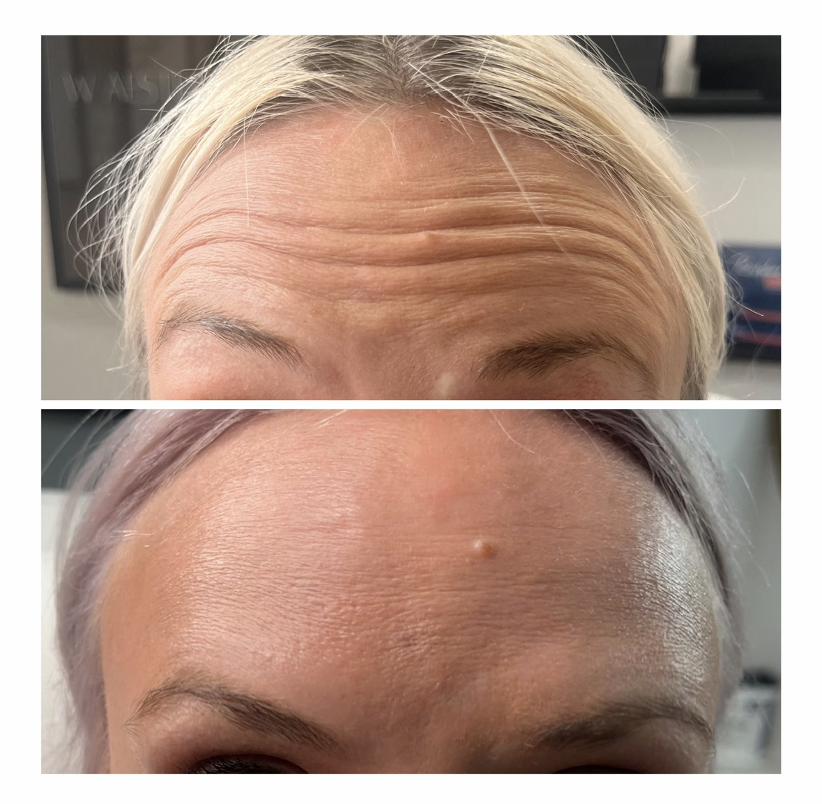 W Aesthetics Botox Before and After. Austin Texas5