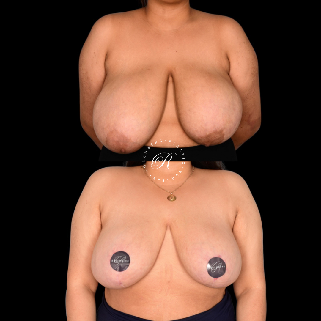 Breast Lift & Reduction RPS Before & Afters.zip - 72
