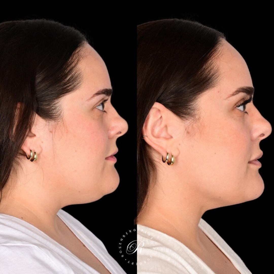 Neck Lipo RPS Before & After.zip - 8