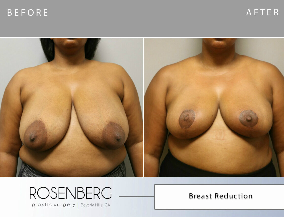 Katrina Gonzales Breast Reduction B&A 2