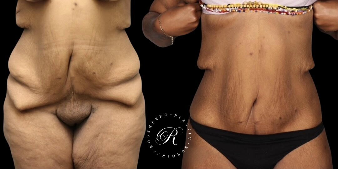 Abdominoplasty RPS Before & After.zip - 11