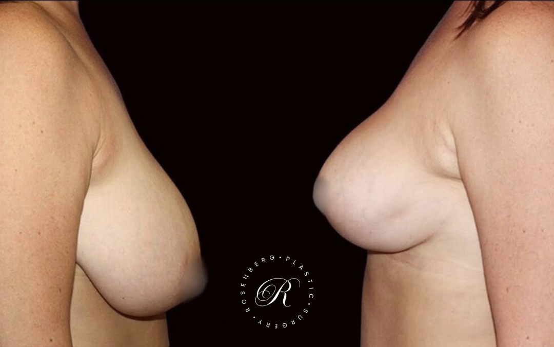 Breast Lift & Reduction RPS Before & Afters.zip - 83